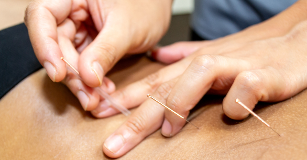 Dry Needling